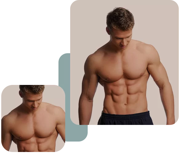 Gynecomastia