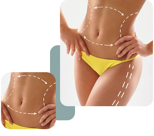 Liposuction