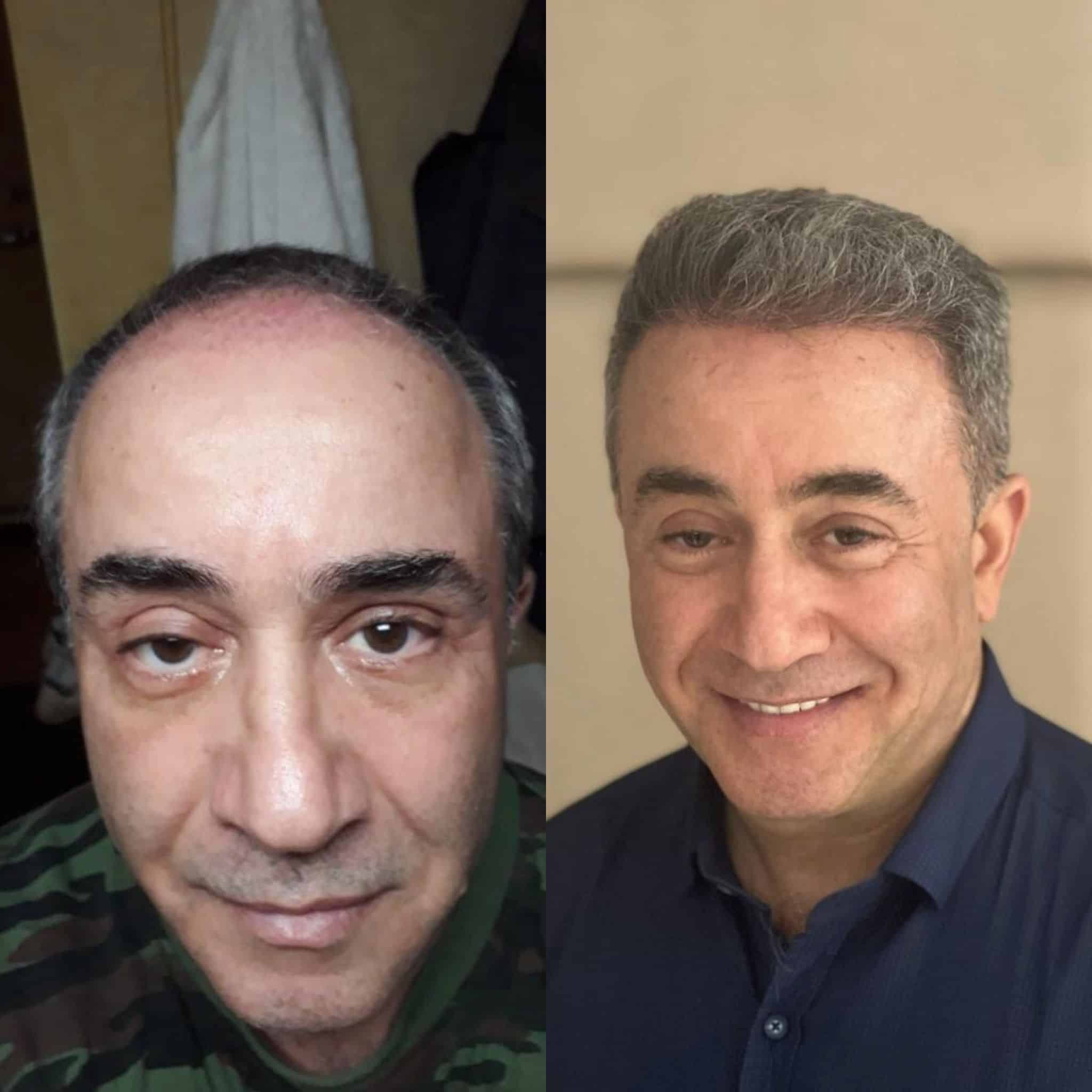 Before and after 1