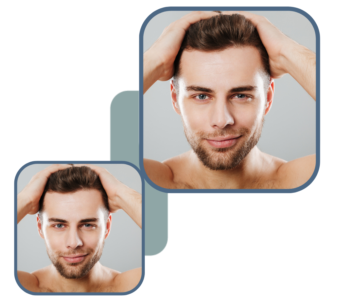Hair transplant illustration