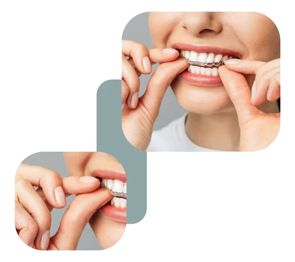 Clear Aligner for teeth straightening