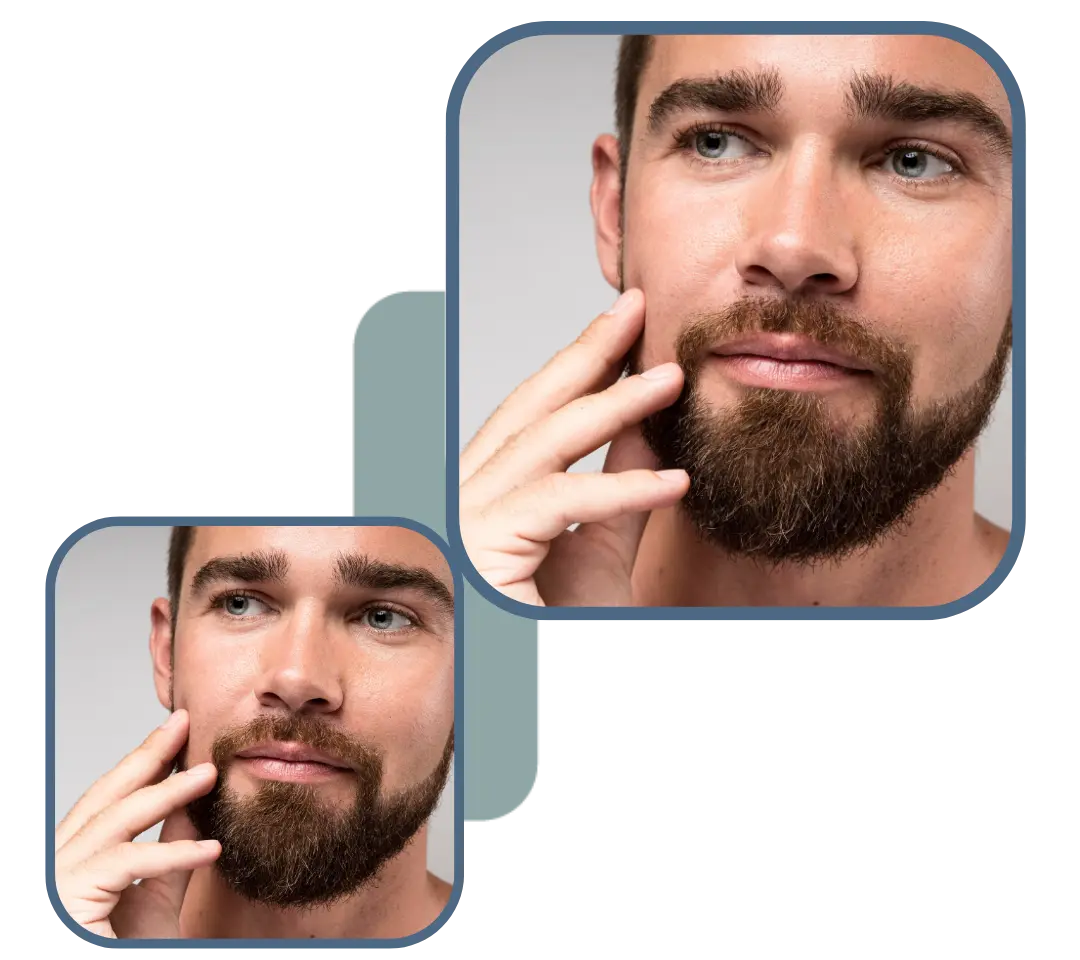 Barttransplantation — Before and After Results