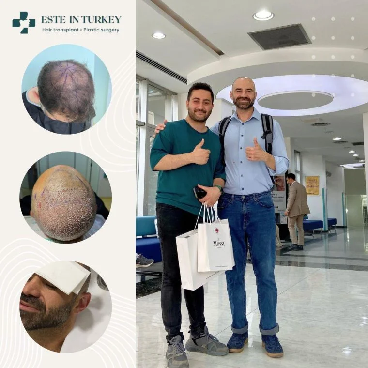 Happy patient — пересадка волос DHI в Стамбуле