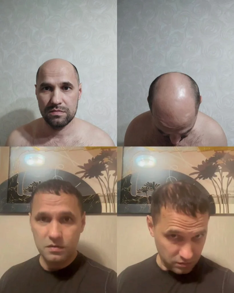 Денис из Мурманска — результат пересадки волос спустя год