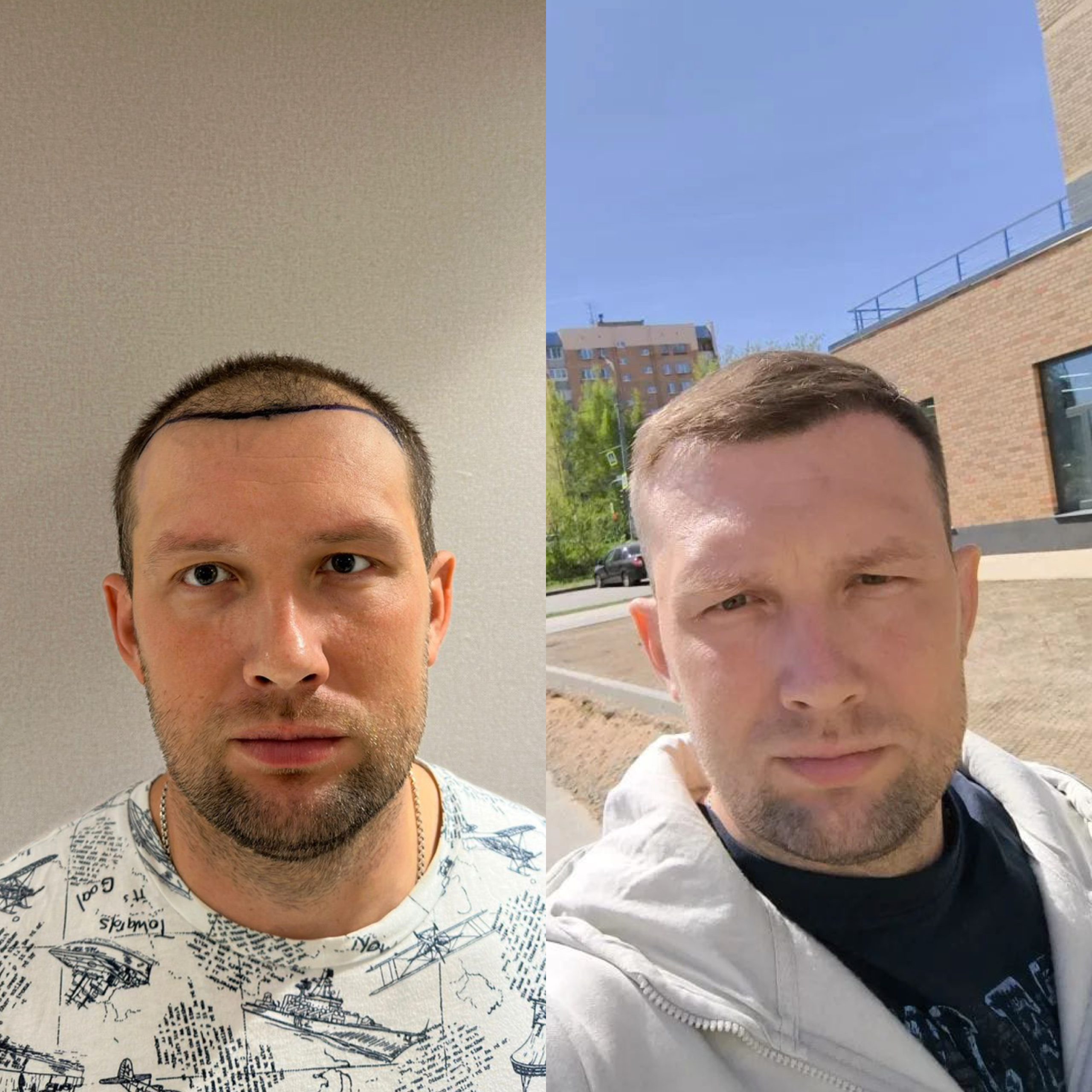 Haartransplantation vorher und nachher — Ergebnis der Haarlinie