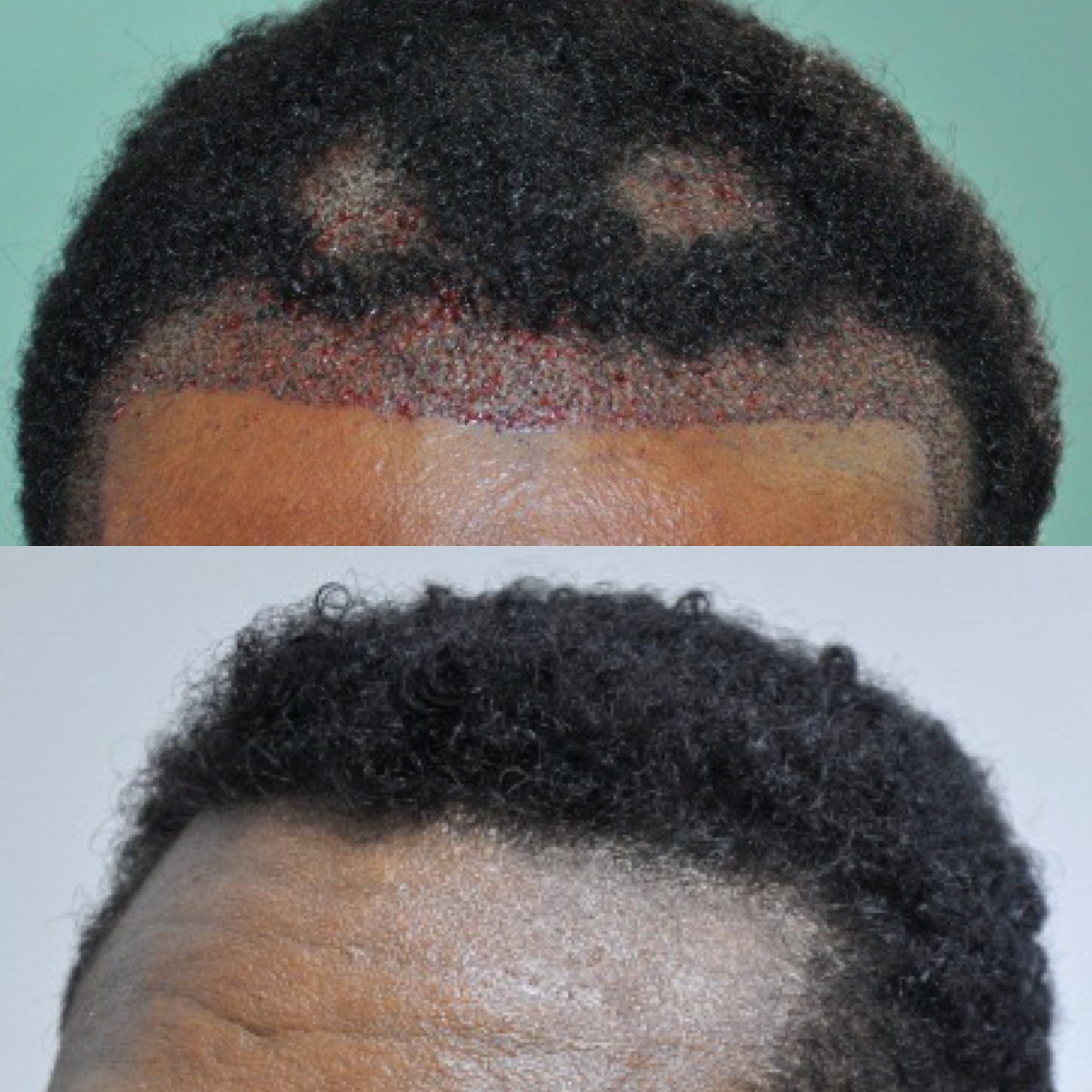Haartransplantation vorher und nachher — wiederhergestellte Haarlinie