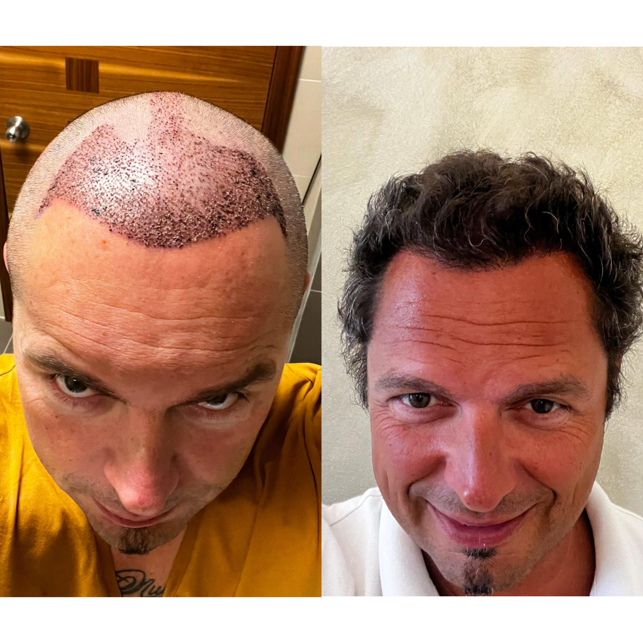 Haartransplantation vorher und nachher — natürliche Haarlinie